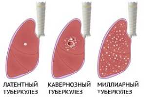 Закрытая форма туберкулеза