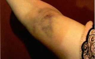 После горячего укола болит рука