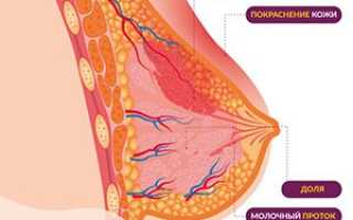 Мастит у кормящей матери