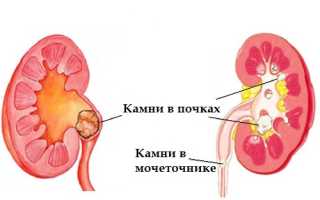 Почечнокаменная болезнь и методики ее лечения