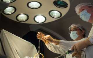 Какие операции показаны при варикоцеле