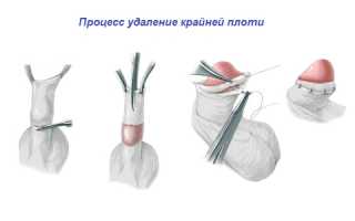 Как ухаживать за половыми органами после обрезания