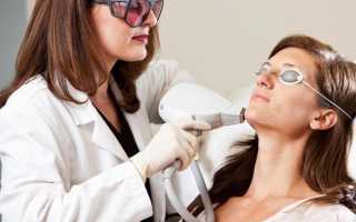 Лазерный пилинг лица — неограниченные возможности аппаратного воздействия