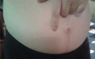 Твердый живот вокруг пупка, что это может быть?