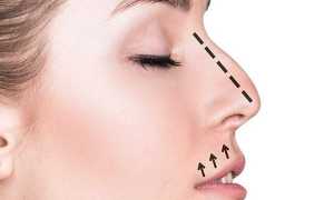 Открытая или закрытая ринопластика: что выбрать для успешной коррекции носа