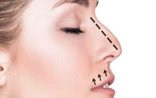 Открытая или закрытая ринопластика: что выбрать для успешной коррекции носа