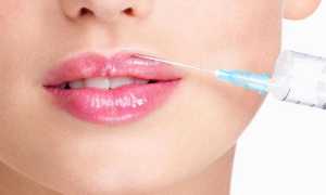 Елена Лядова и другие знаменитости, которые увеличили губы