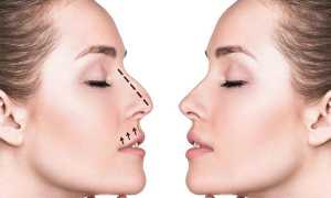 Неудачная ринопластика — ошибка хирурга или пациента