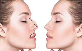 Неудачная ринопластика — ошибка хирурга или пациента