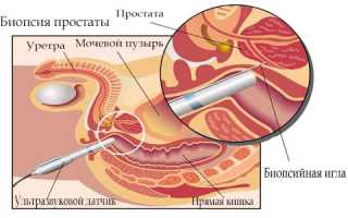 Показания к проведению биопсии простаты и техника ее проведения