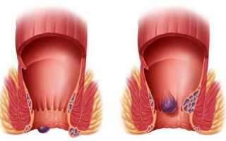 Эффективное домашнее лечение геморроя