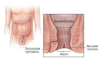 Трещина заднего прохода – срочно к проктологу!