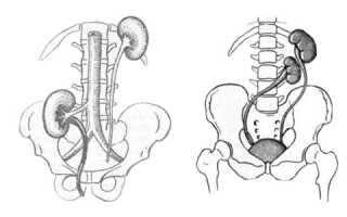 Почему почка располагается неправильно и как жить с подобной аномалией
