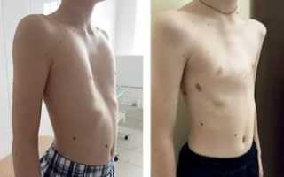 Несимметричность ребер