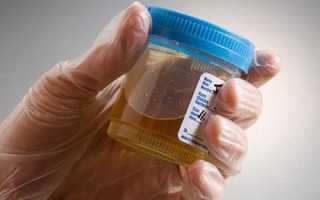 Почему мутнеет моча и с чем это может быть связано