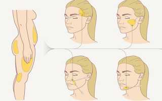 Липофилинг лица: опасна ли процедура и сколько длится эффект