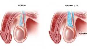 Безоперационное лечение варикоцеле — миф или правда?
