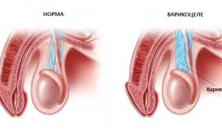 Безоперационное лечение варикоцеле — миф или правда?