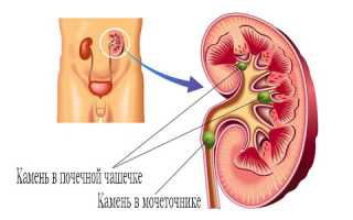 Микролиты почек — как они себя проявляют и нужно ли их лечить