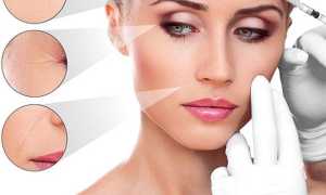 Векторный лифтинг: альтернатива пластике или коммерческий ход косметологов