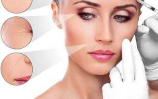 Векторный лифтинг: альтернатива пластике или коммерческий ход косметологов