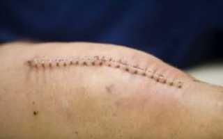 Боль после снятия швов