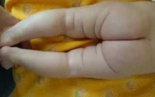 Несимметричные складки у ребёнка, как быть?
