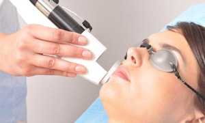 Удаление пигментных пятен на лице лазером: высоки ли риски и эффективность