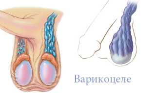 Чем опасно варикоцеле и его рецидивы