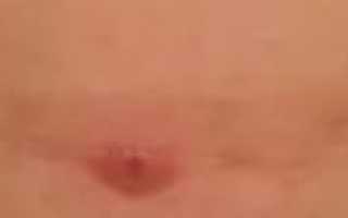Уплотнение под кожей после заживления раны