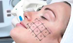 Термаж — мгновенное омоложение или усугубление возрастных проблем