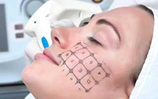 Термаж — мгновенное омоложение или усугубление возрастных проблем