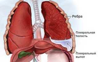 Экссудативный плеврит