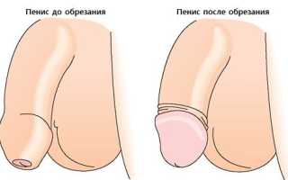 Нужно ли мужчинам делать обрезание