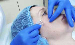 Тредлифтинг — важные особенности процедуры подтяжки и мнение косметологов