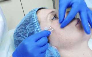 Тредлифтинг — важные особенности процедуры подтяжки и мнение косметологов