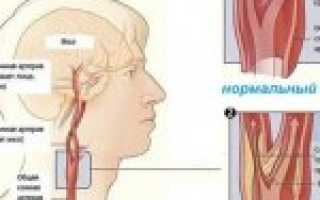 Ангиопатия сосудов головного мозга: симптомы, диагностика и лечение