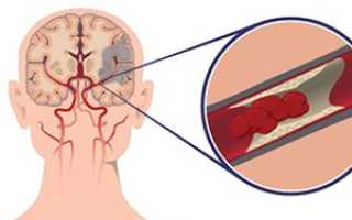 Ишемический инсульт головного мозга
