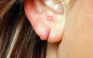 Порвал мочку уха