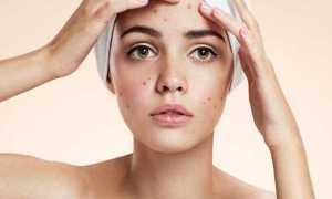 Лучшие пилинги для проблемной кожи: салонные процедуры и домашние средства