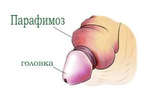 Почему может произойти сдавливание головки пениса и как его лечить