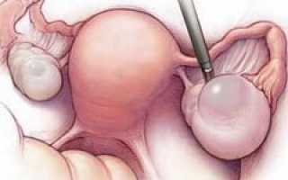 Киста яичника