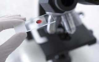 Анализ крови на глюкозу