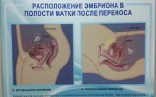 Запоры после переноса эмбриона