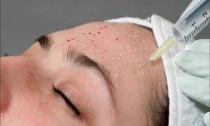 Мезотерапия с витамином С: безобидное и эффективное омоложение кожи лица