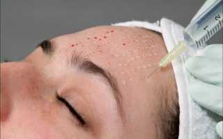 Мезотерапия с витамином С: безобидное и эффективное омоложение кожи лица