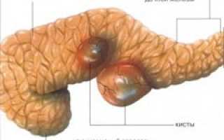 Киста поджелудочной железы