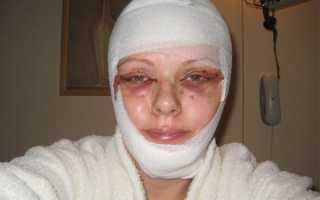 Как ускорить восстановление и избежать осложнений после пластики лица