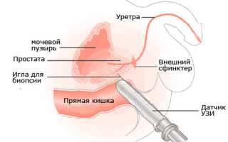 Как делают УЗИ предстательной железы?