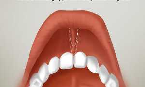 Может ли пластика уздечки верхней губы решить эстетические и функциональные проблемы рта